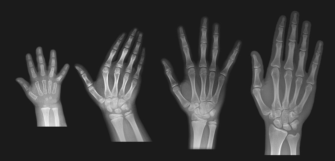 Hand X-Ray, Normal, Series