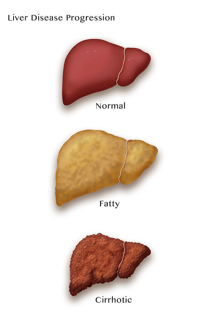 Liver Disease Progression, Illustration