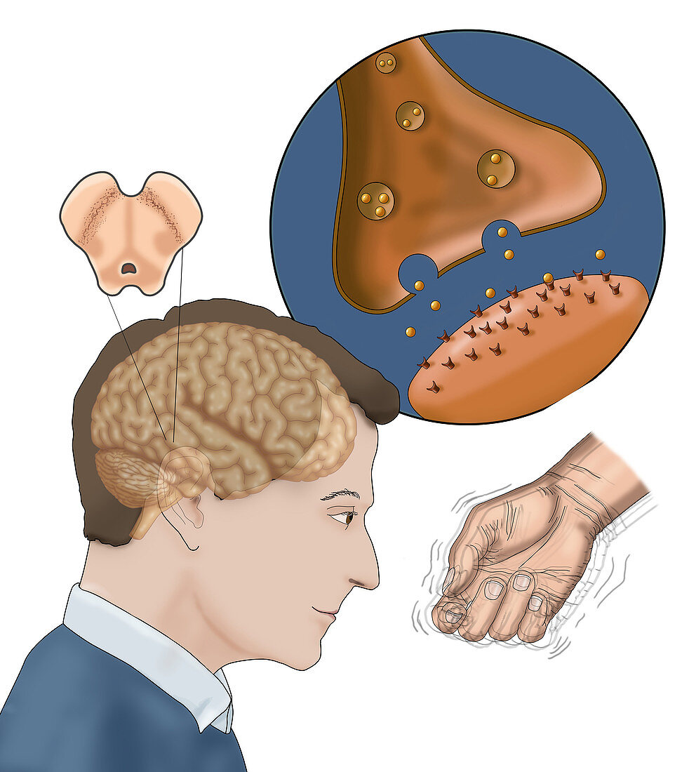 Dopamine & Parkinson's, Illustration