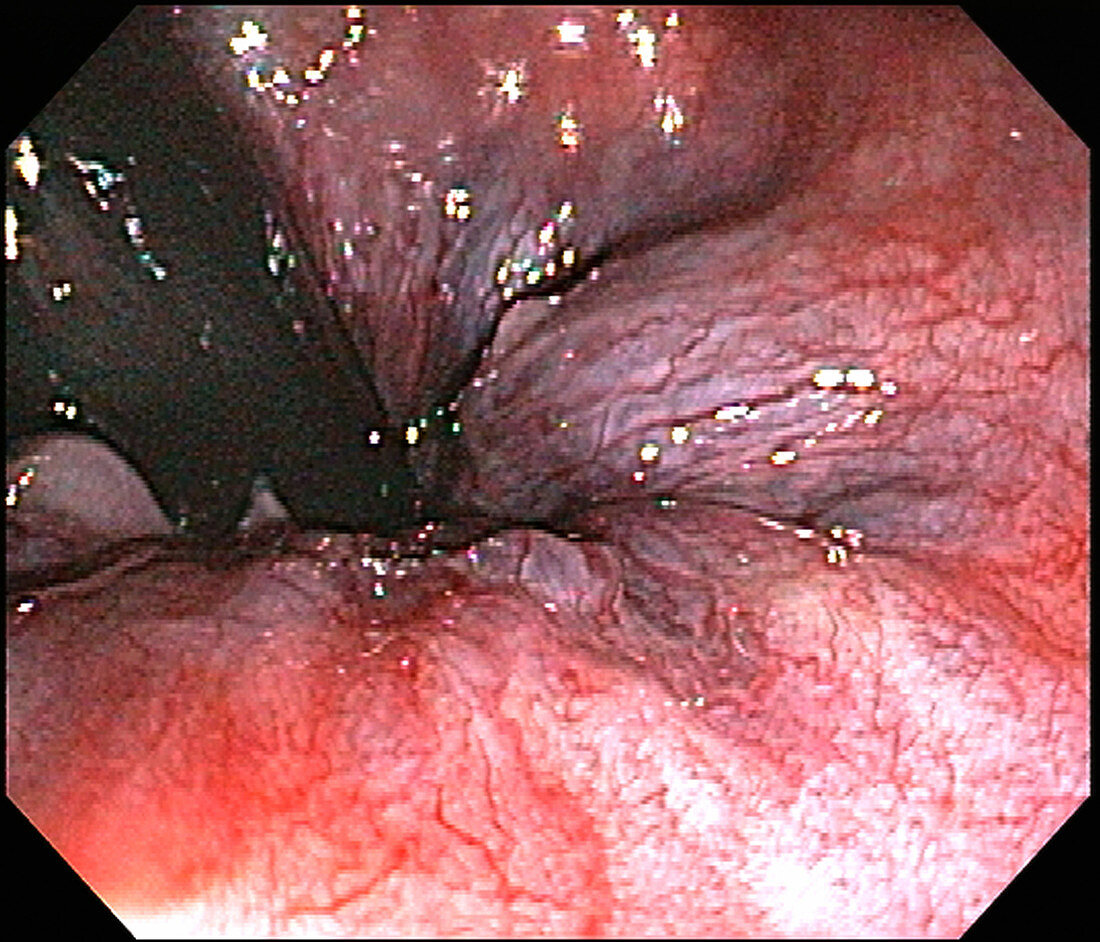 Haemorrhoids, Endoscopic View