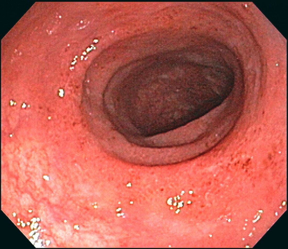 Minimal Ulcerative Colitis
