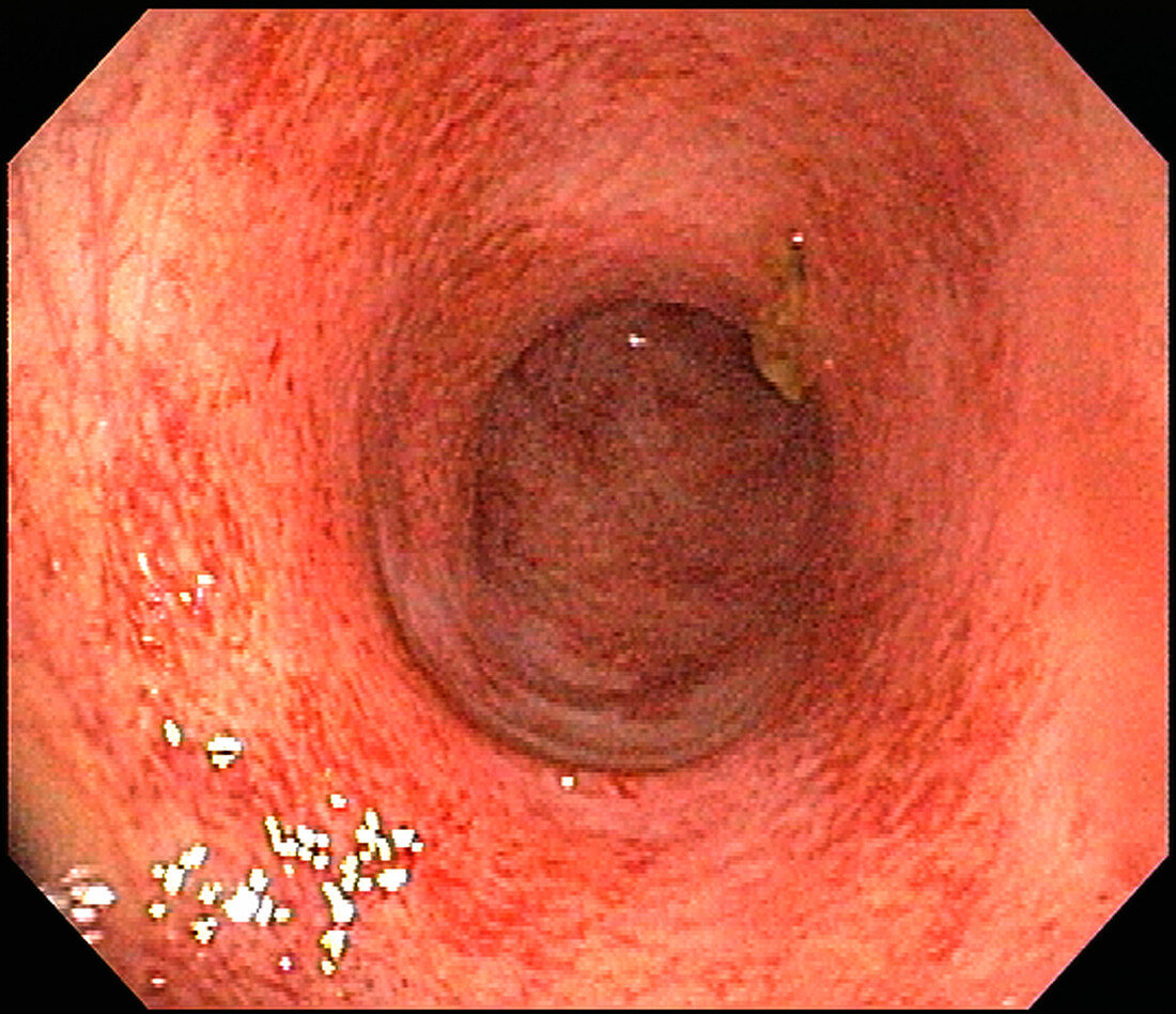 Minimal Ulcerative Colitis