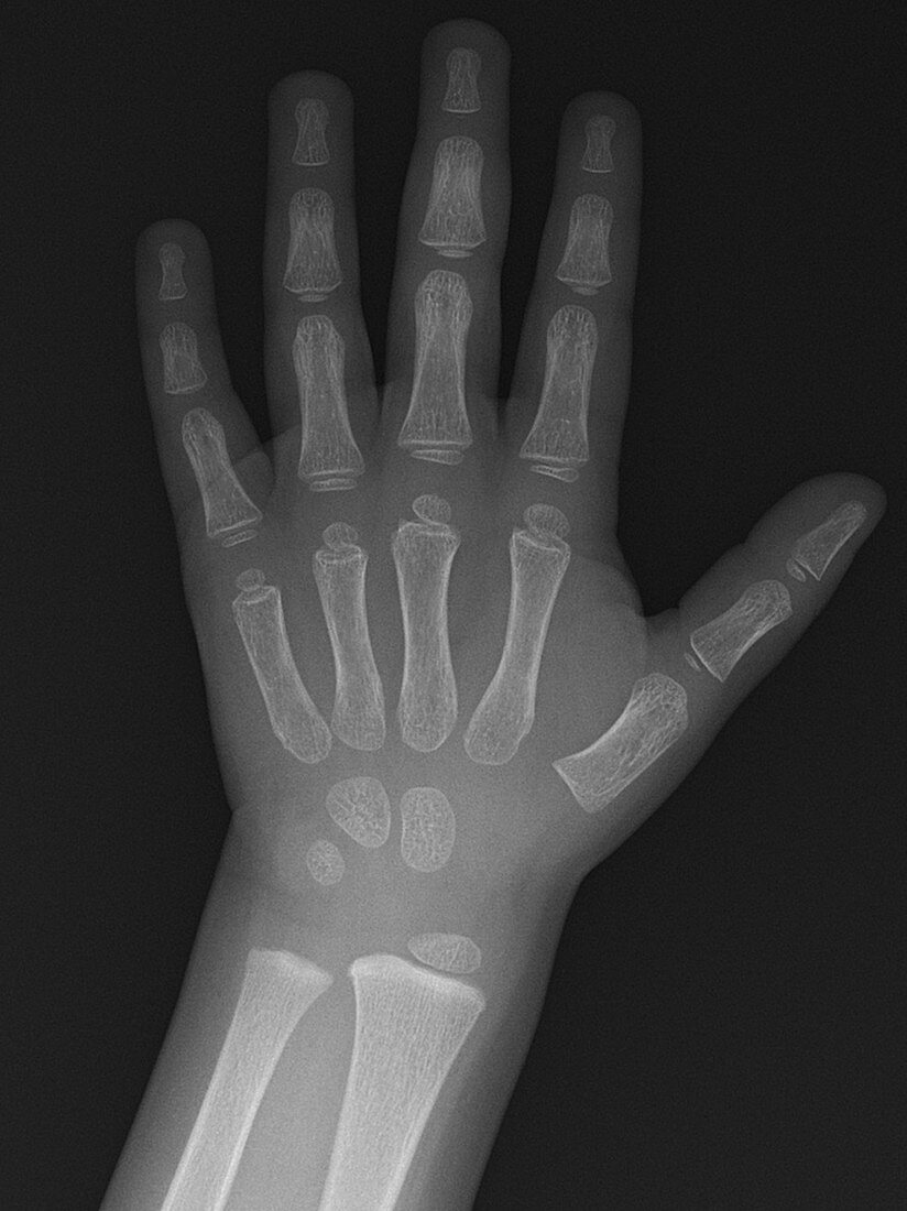 Hand X-Ray, Normal