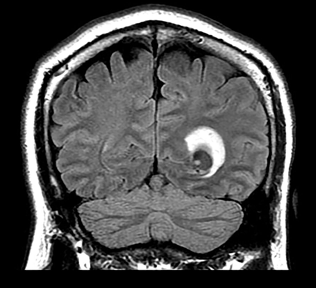 Cysticercosis, MRI
