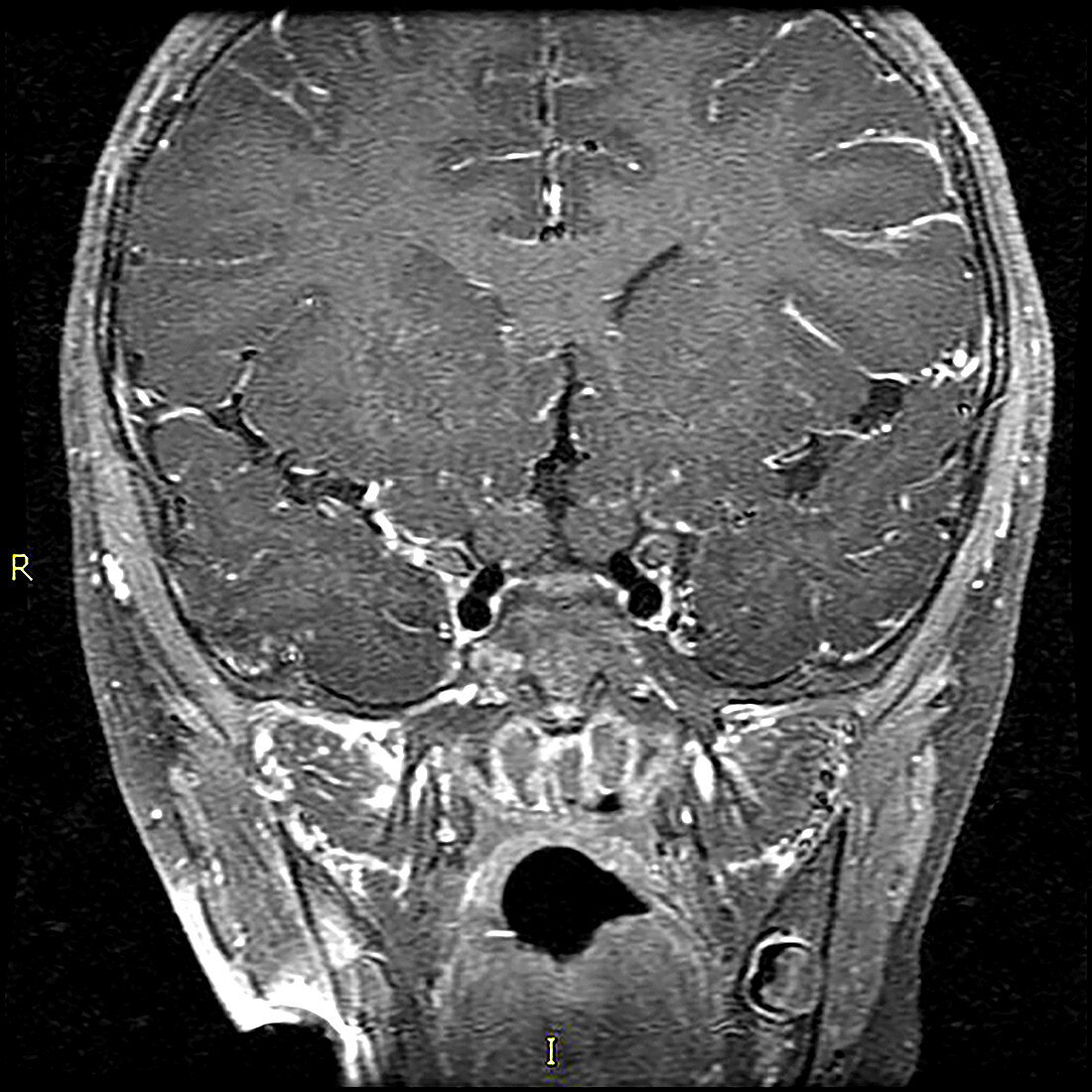 Neurofibromatosis type I (NF1), MRI