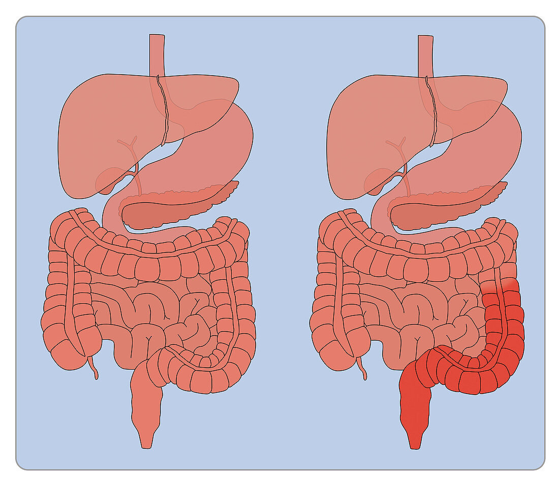 Normal Digestive System and Ulcerative Colitis