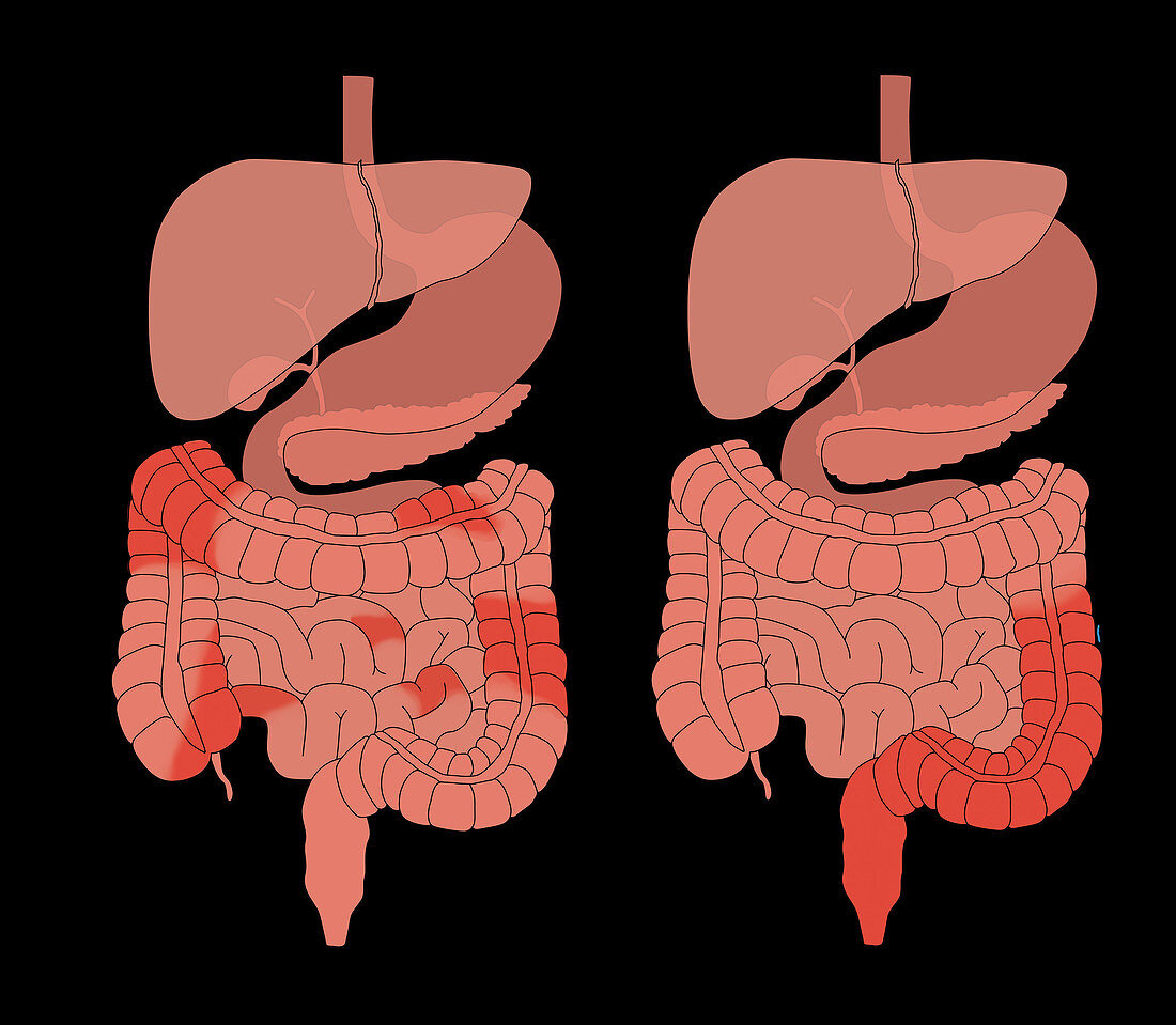 Crohn's Disease & Ulcerative Colitis, Comparison