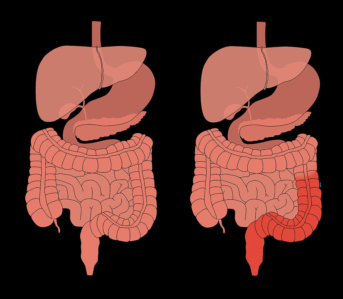 Healthy Digestive System & Colitis, Comparison
