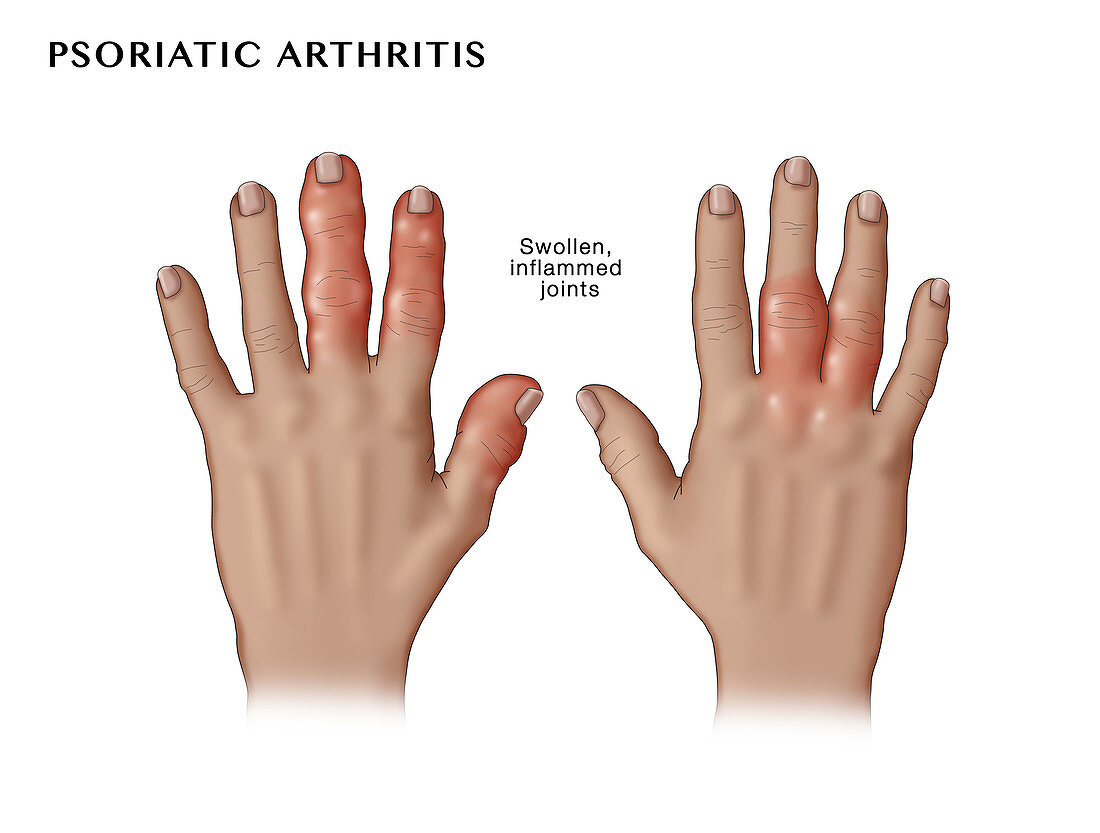 Psoriatic Arthritis