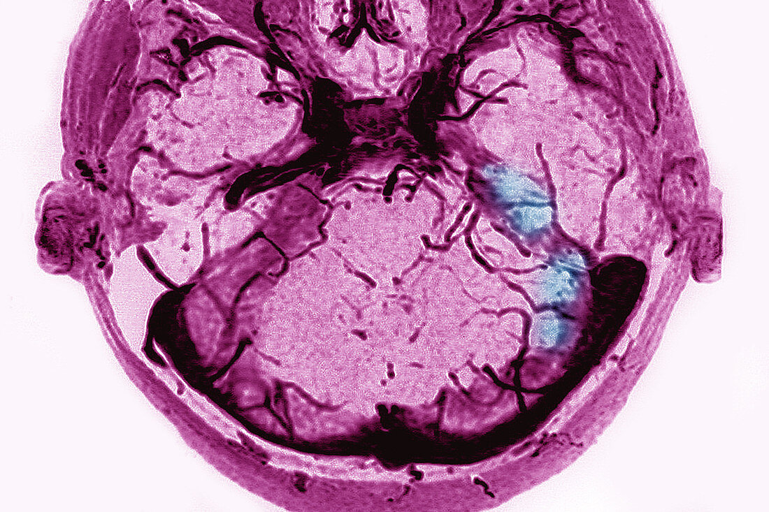 Thrombosis of Venous Sinuses, Dura Mater, MRI