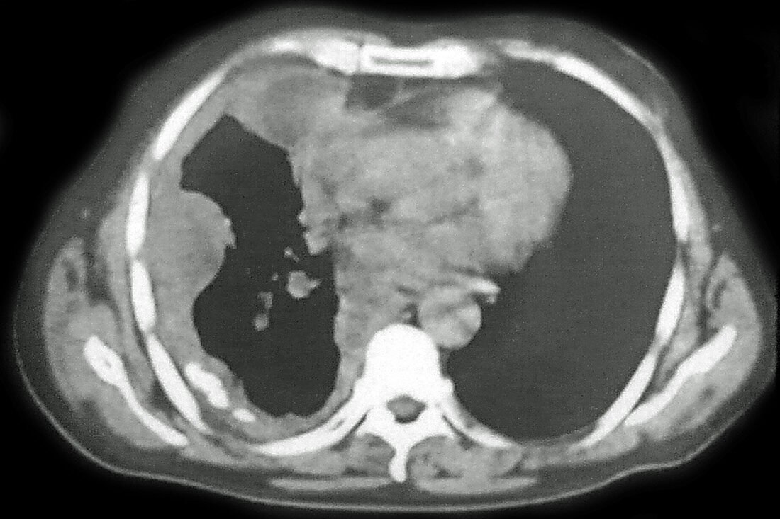 Lung Cancer, CT Scan