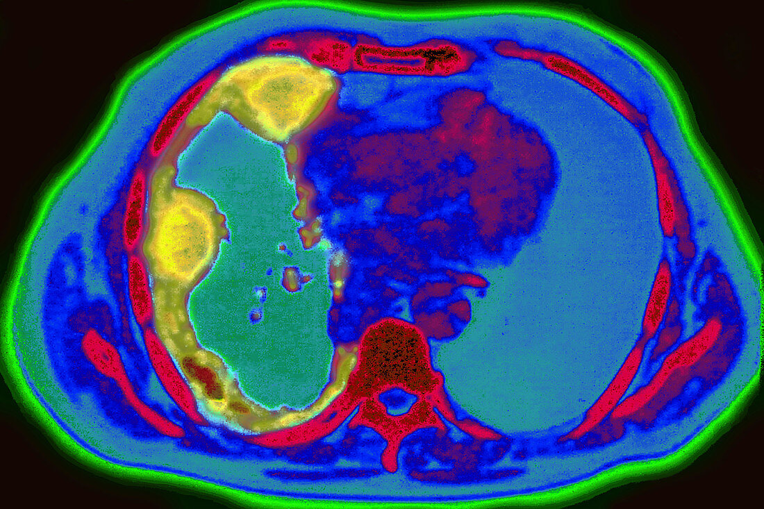 Lung Cancer, CT Scan