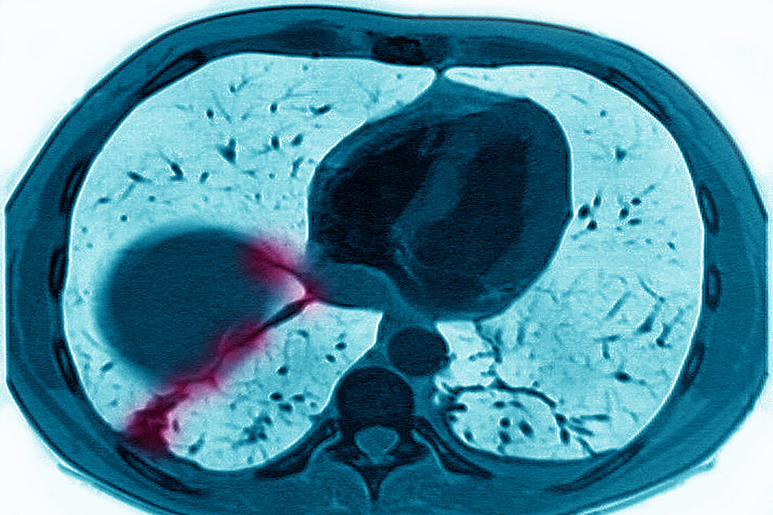 Pulmonary Infarction, CT Scan