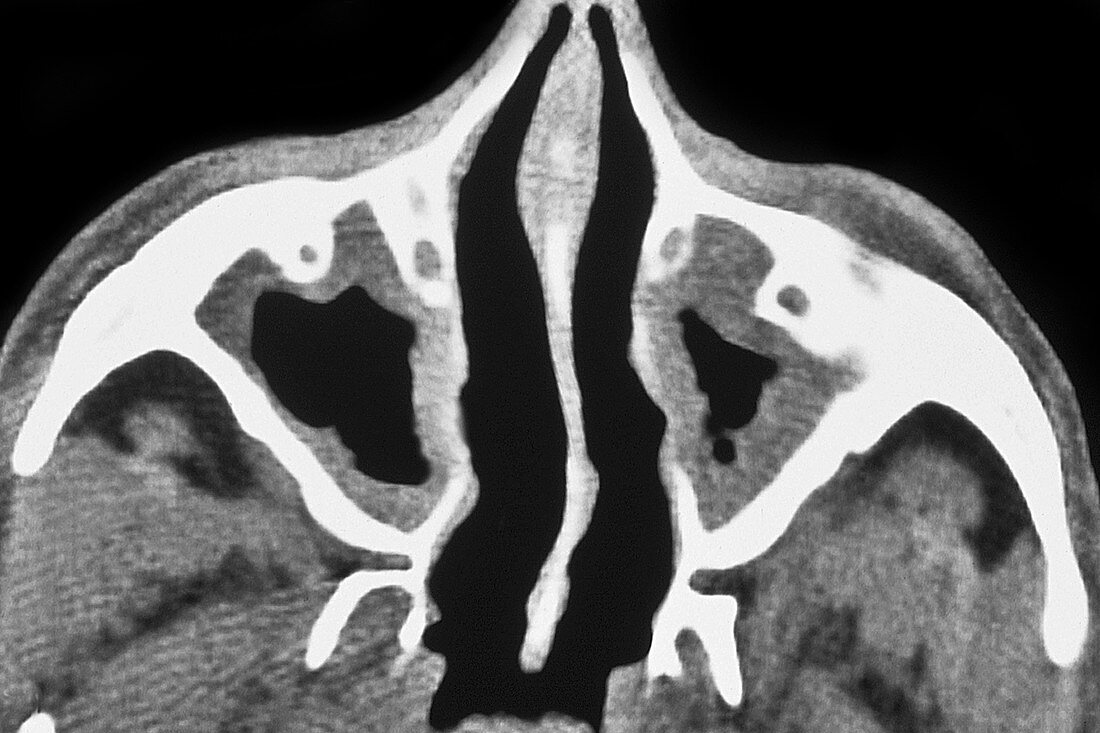 Maxillary Sinusitis, CT Scan