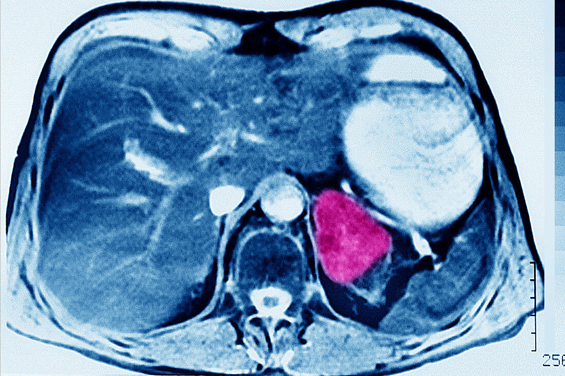 Malignant Adrenocortical Tumour, CT Scan