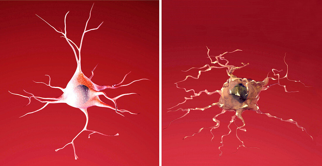 Normal and Dying Neuron, Alzheimer's Disease