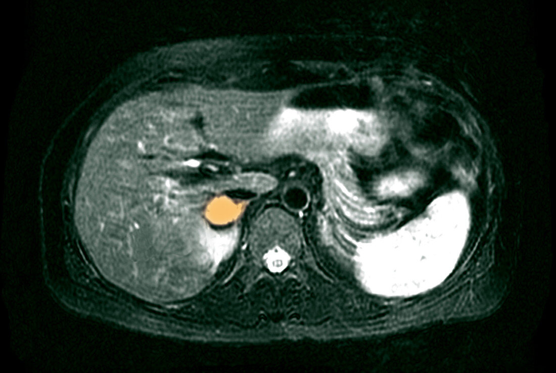 Adrenal Pheochromocytoma, MRI