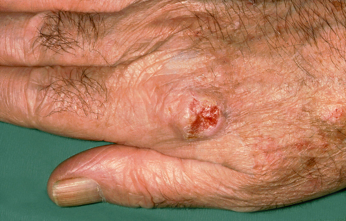 Squamous Cell Carcinoma on Knuckle