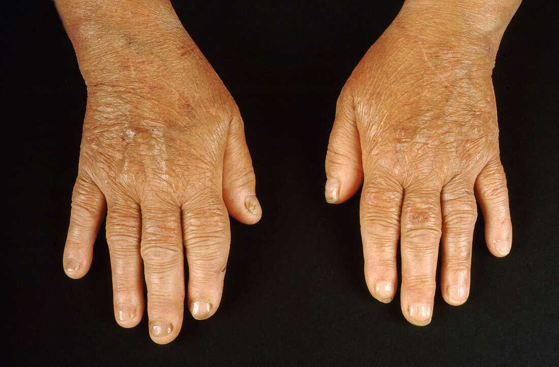 Hypothyroidism, Hands