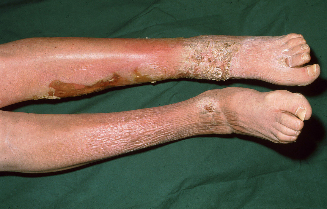 Thyroid Acropachy, Pretibial Myxoedema