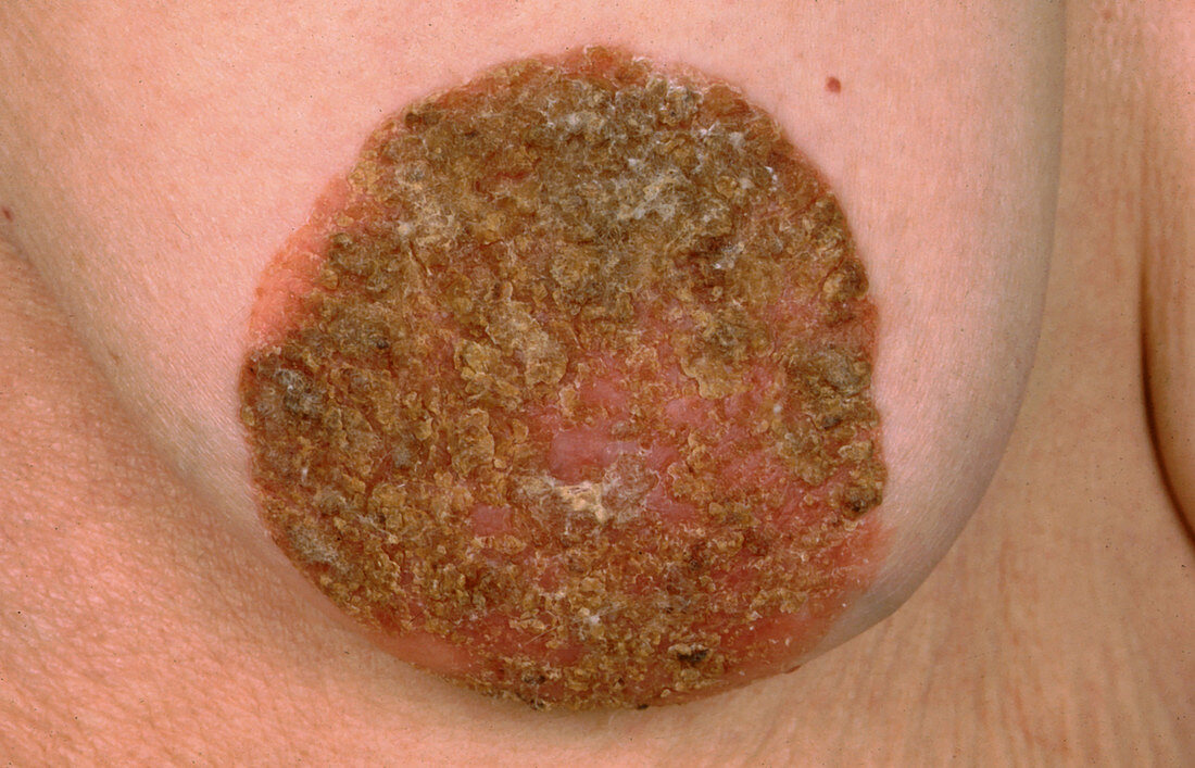Paget Disease of Breast
