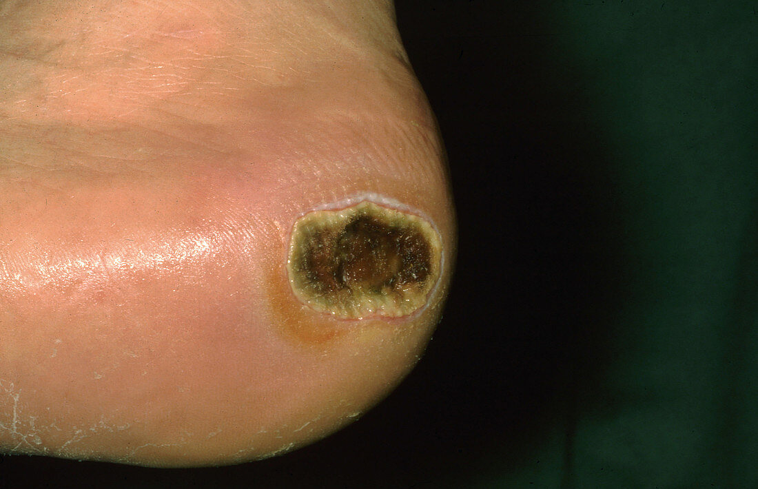 Diabetic Heel Ulcer