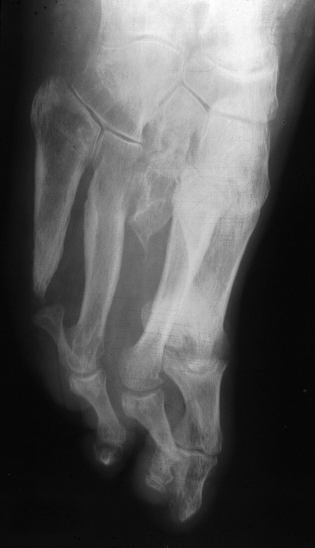 Gangrene from Diabetes, Foot X-Ray