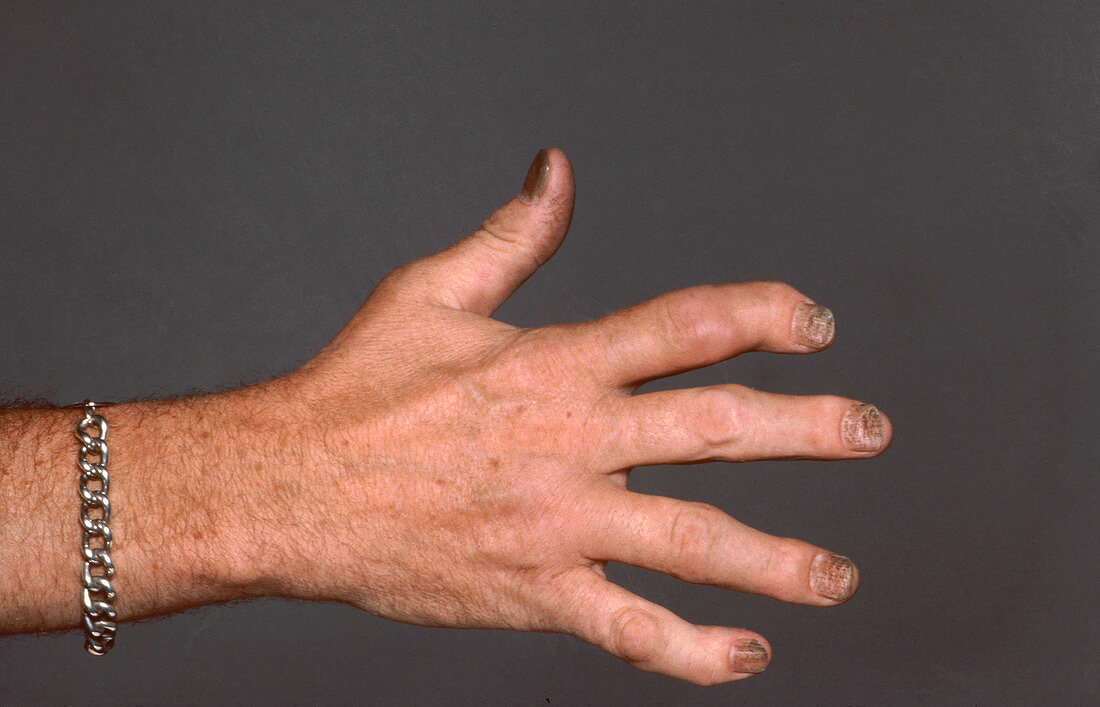 Psoriatic Arthritis, Hand
