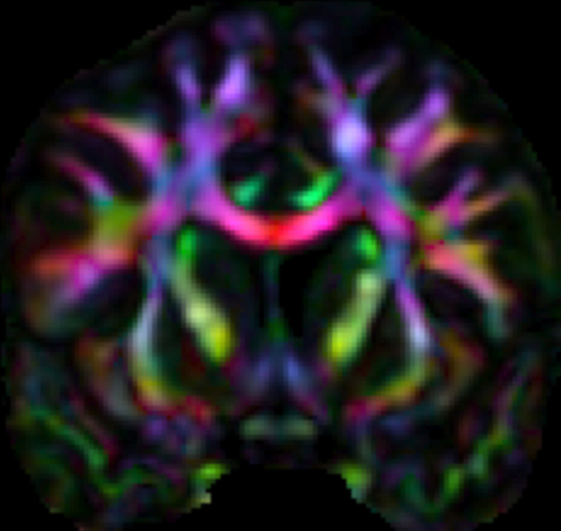 White matter brain tracts, DTI