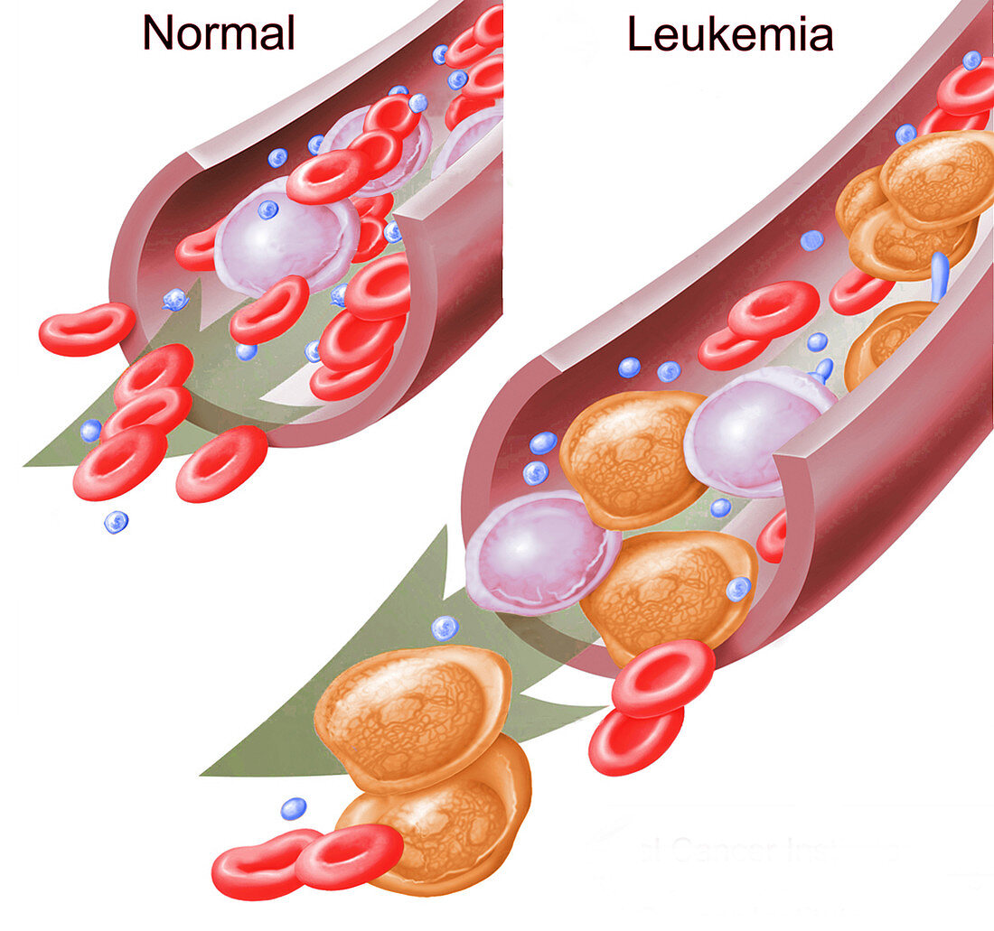 Normal Blood Cells and Leukaemia