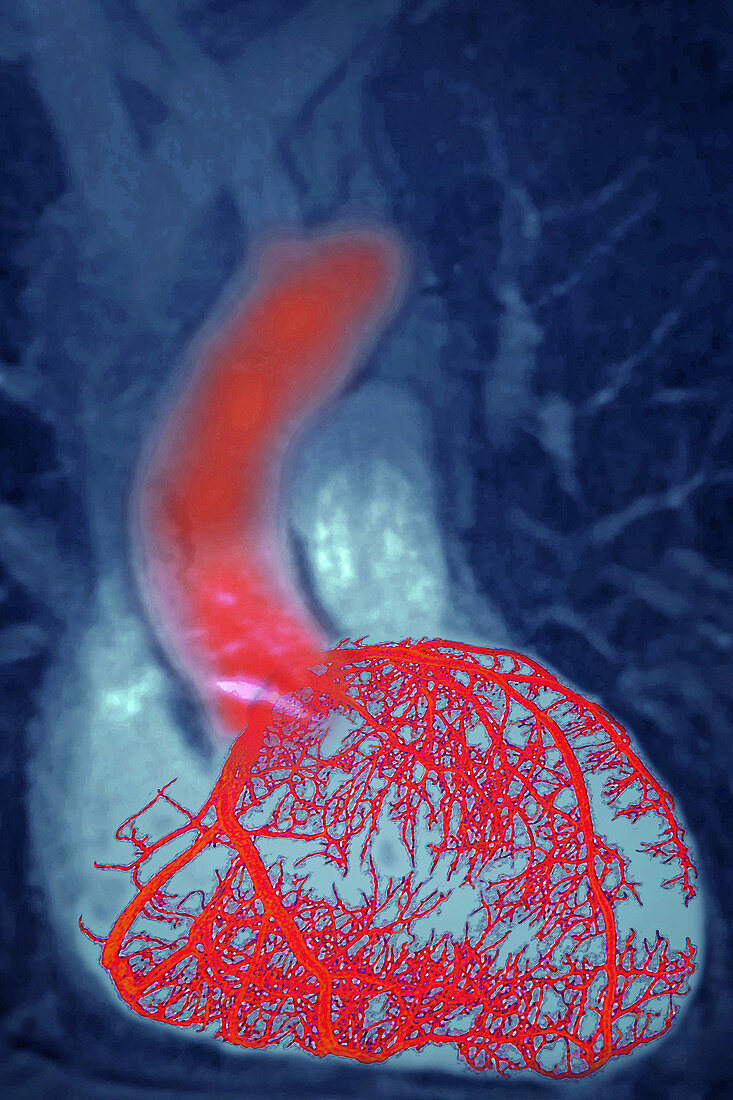 Coronary arteries