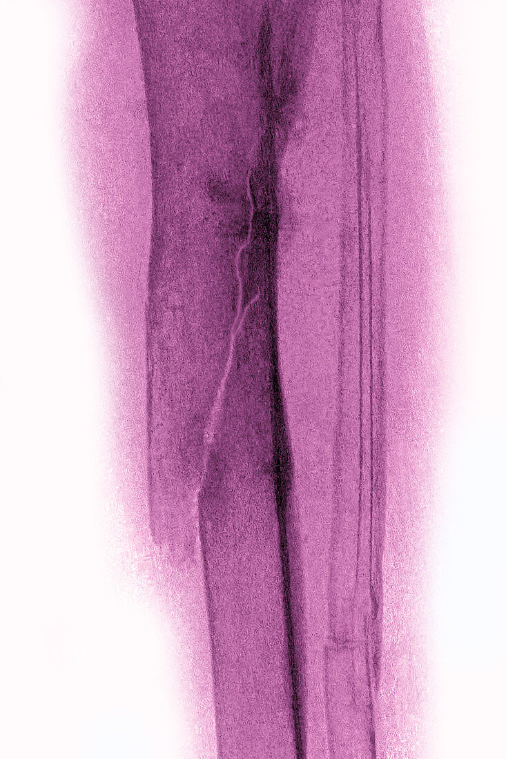Fracture resulting from osteoporosis, X-ray