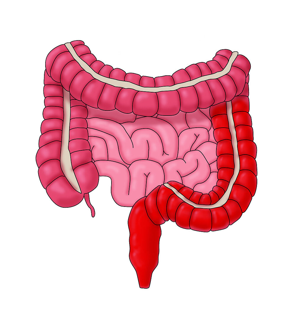 Ulcerative Colitis Typical Location, Illustration