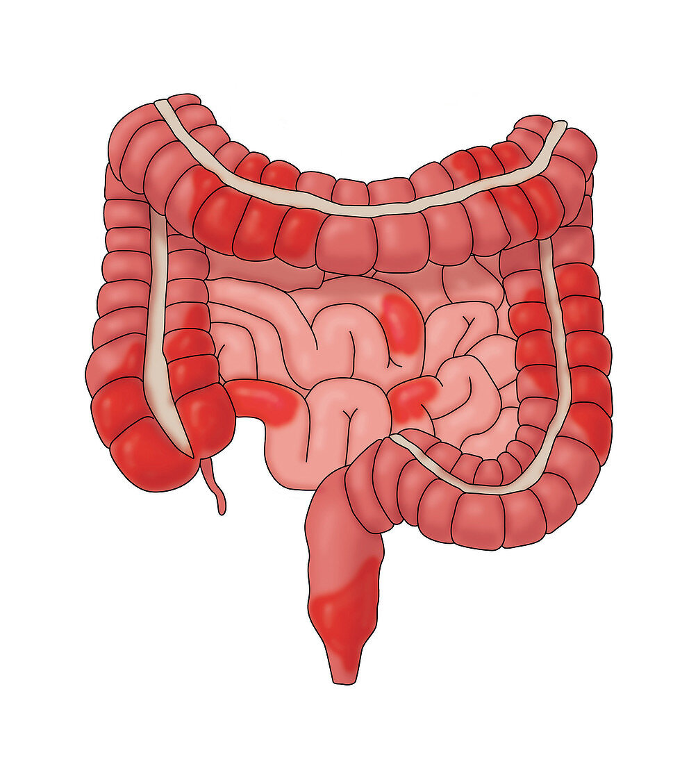 Crohn's Disease Possible Locations, Illustration