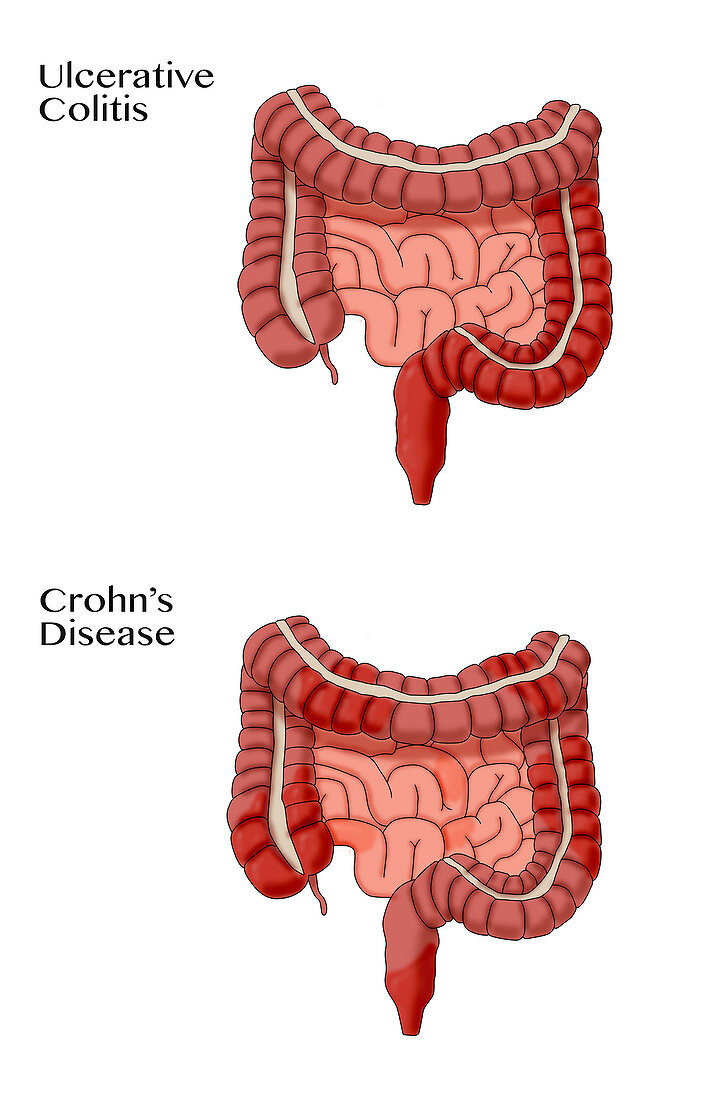 Colitis & Crohn's Disease, Illustration