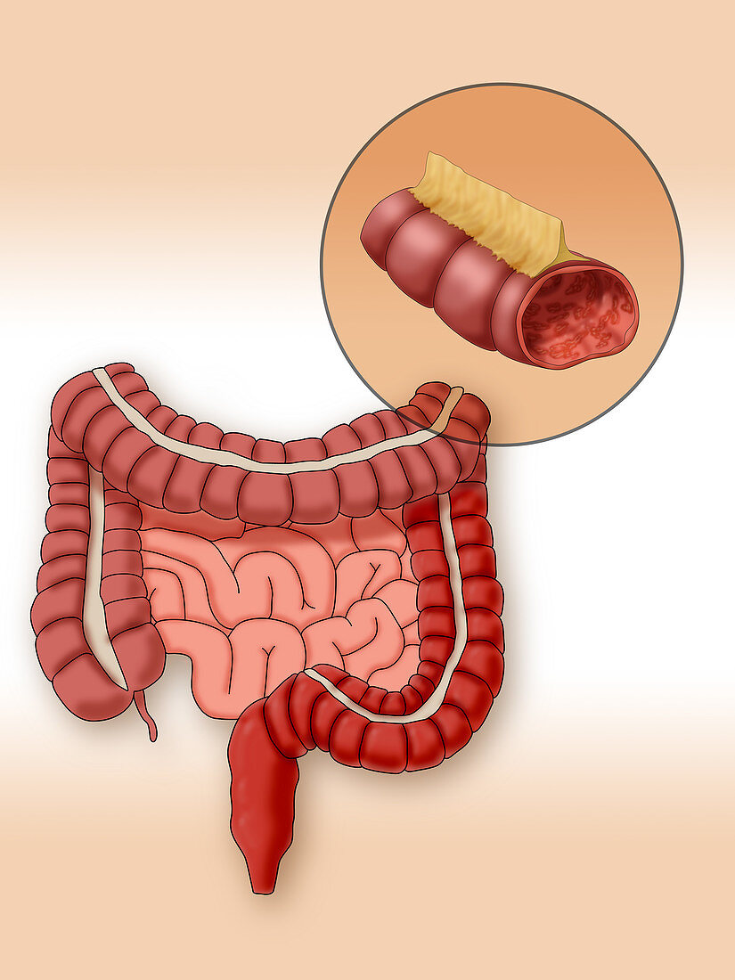 Ulcerative Colitis, Illustration