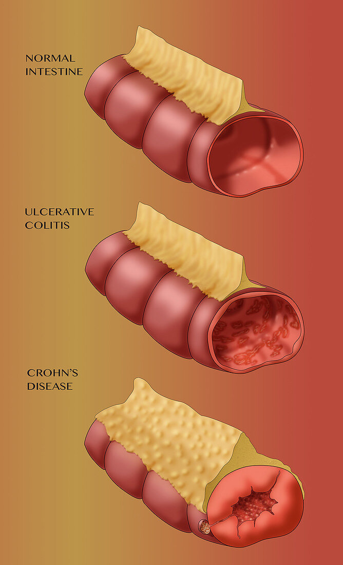 Healthy Intestine, Colitis & Crohn's Disease