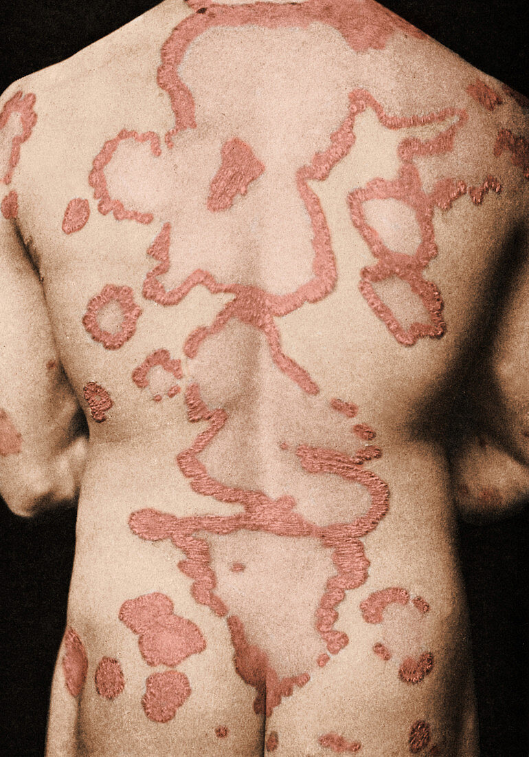 Plaque Psoriasis on Back