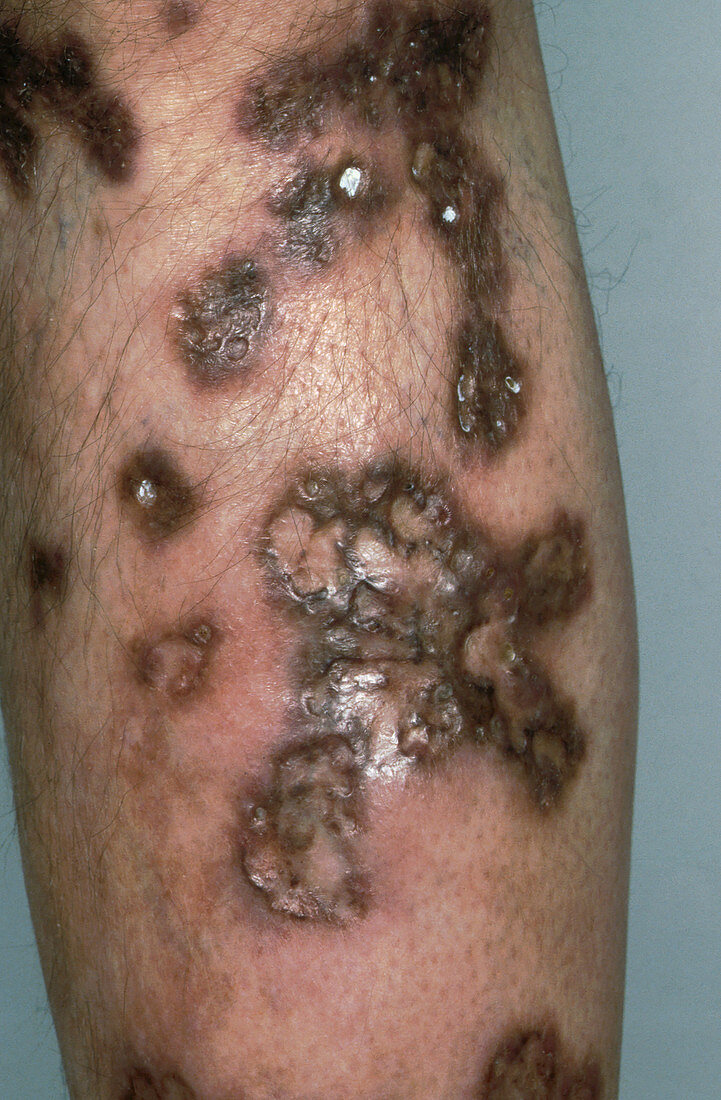 Ulcerative sarcoidosis