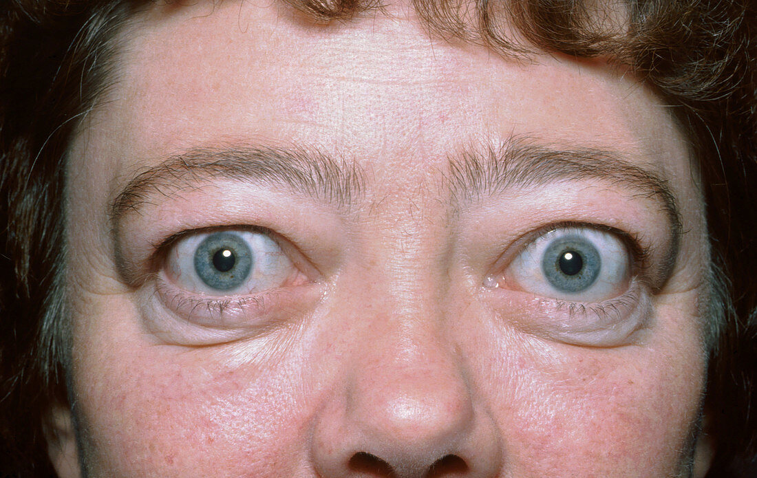 Graves' ophthalmopathy