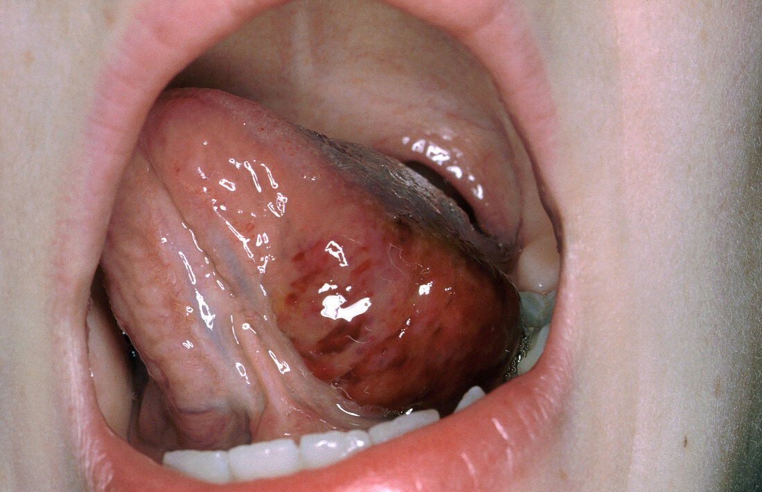 Hemangioma on tongue