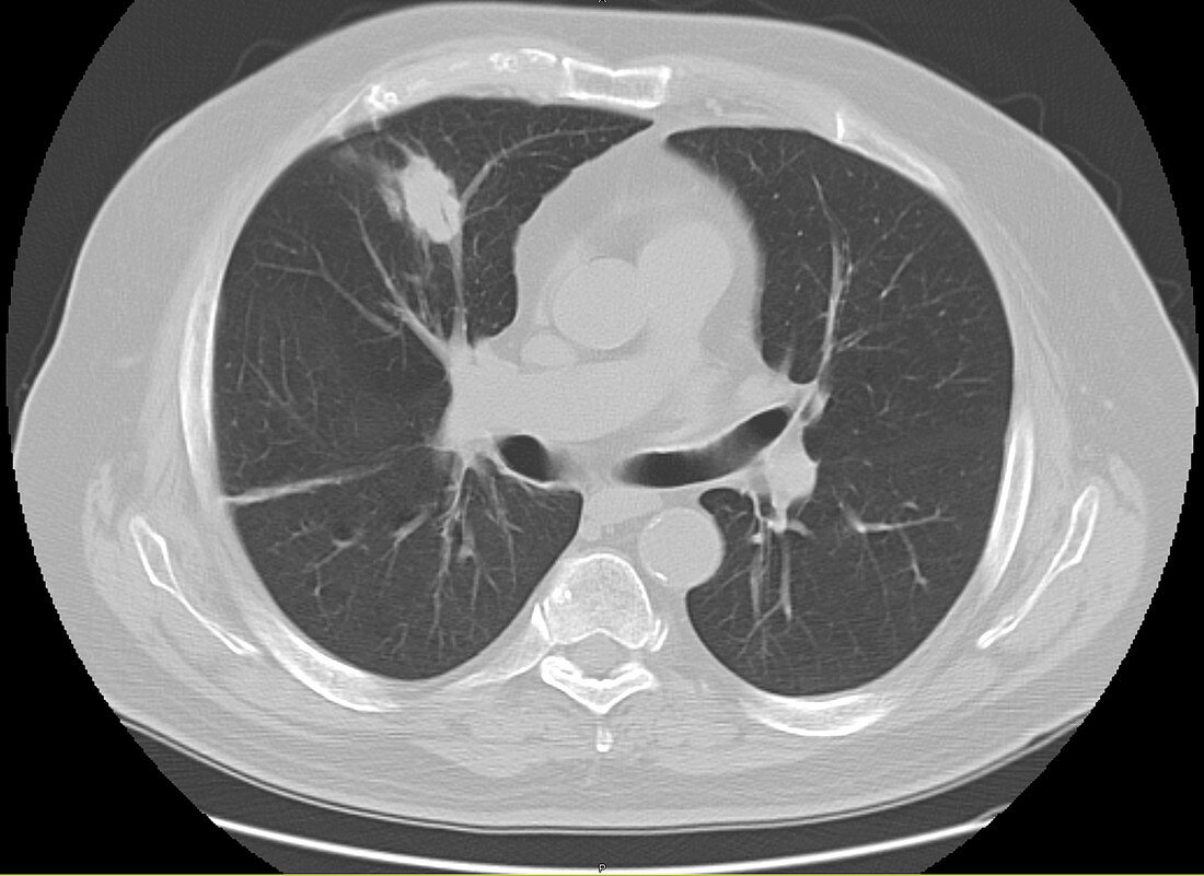 Adenocarcinoma of the lung, CT scan
