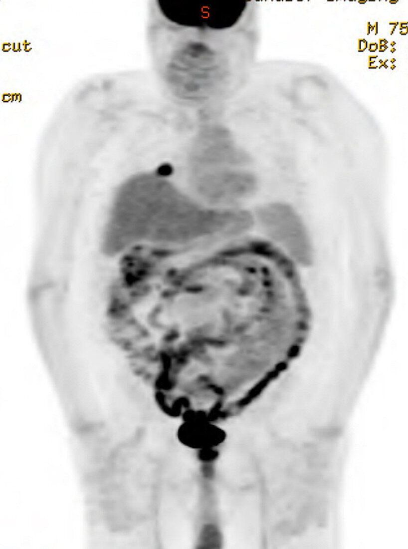 Adenocarcinoma of the lung, PET scan