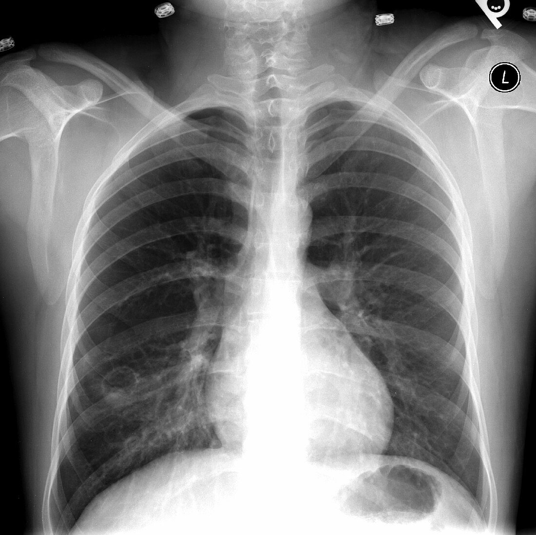 Aspergillosis, X-ray