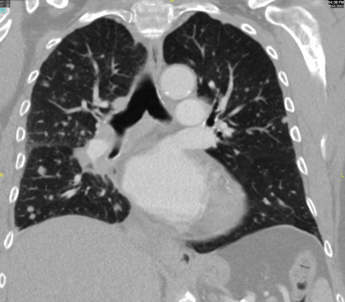 Diffuse pulmonary metastases, CT scan