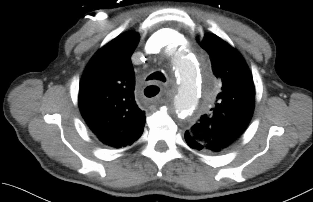 Mediastinal hematoma, CT scan