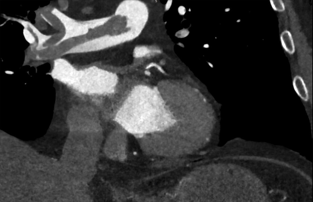 Pulmonary thromboembolism, CT angiogram