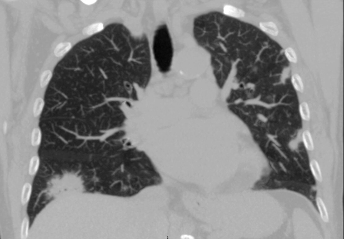 Eosinophilic pneumonia, CT scan