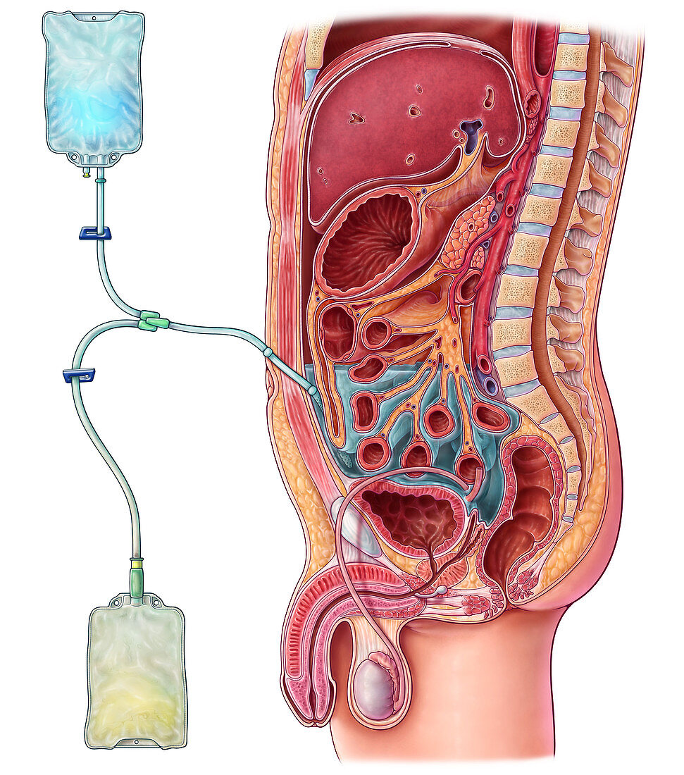 Peritoneal Dialysis, Illustration