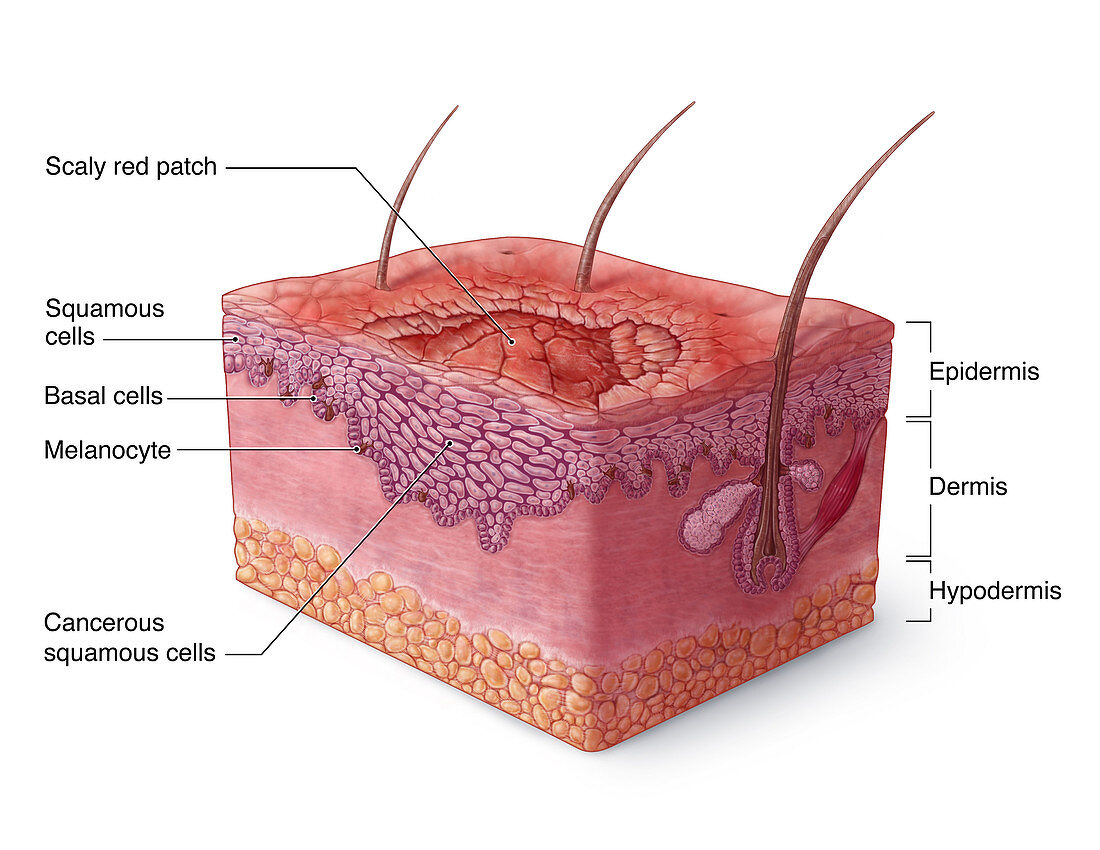 Squamous Cell Carcinoma Illustration